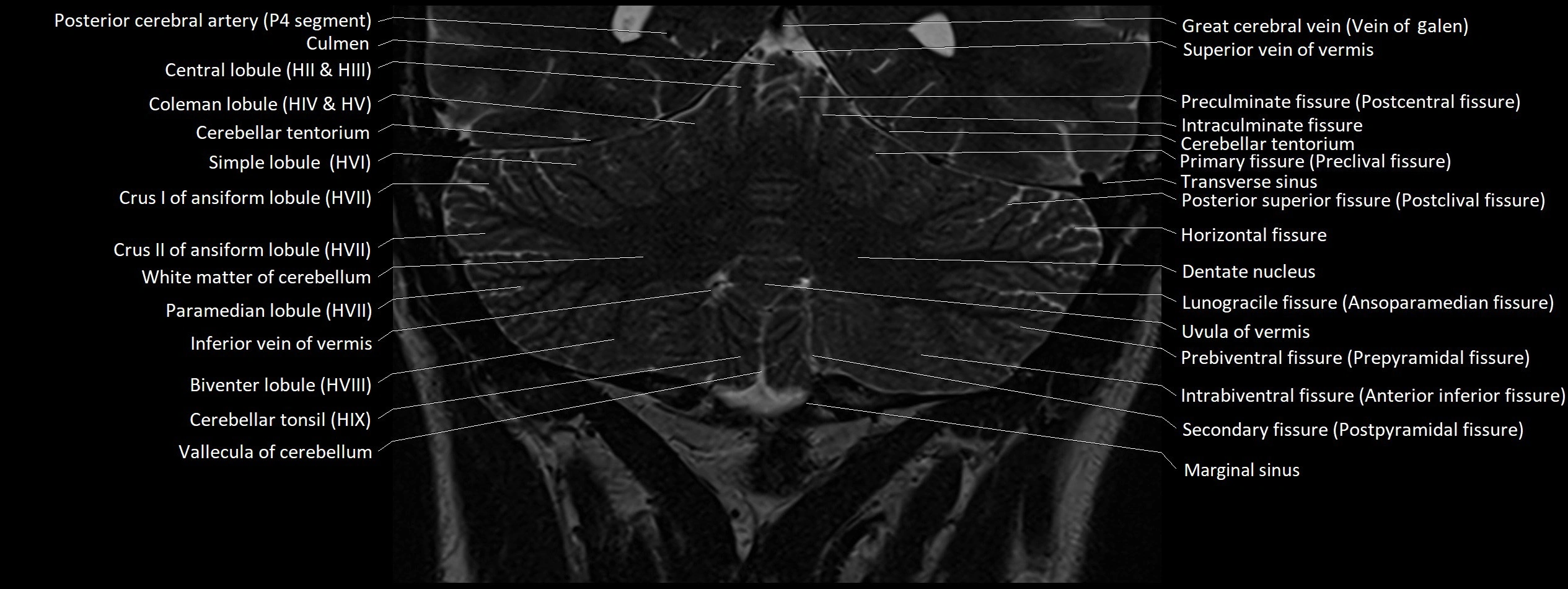 Anatomy of cerebellum coronal cross sectional 3T image 16.webp